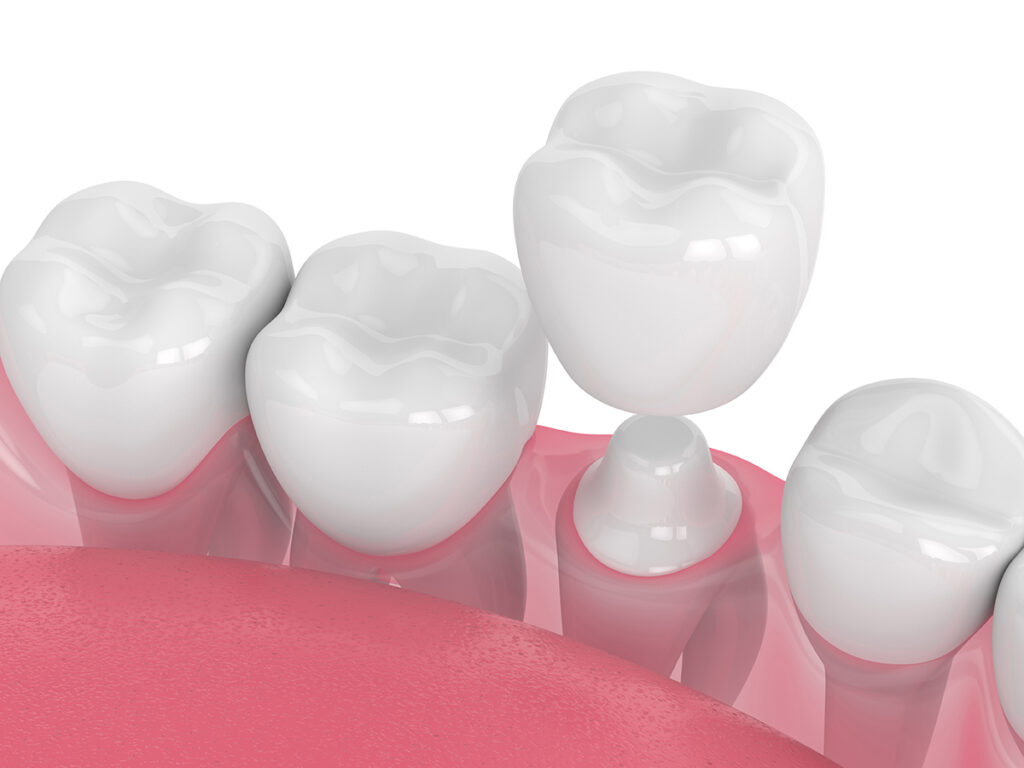 Dental Implants Glendale, AZ | Affordable Dental Implants Services | Wynn Dental Care
