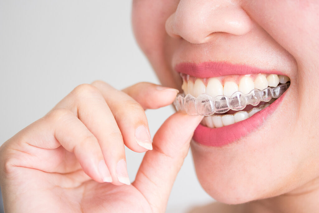 crowded teeth Invisalign Glendale