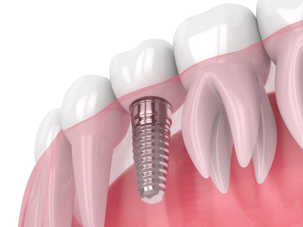 dental implants Glendale best dentist
