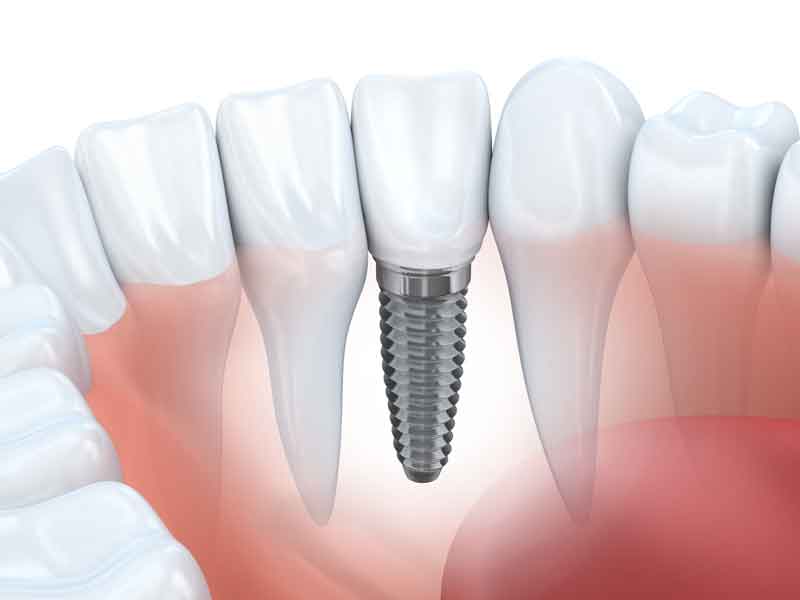 dental implants glendale az