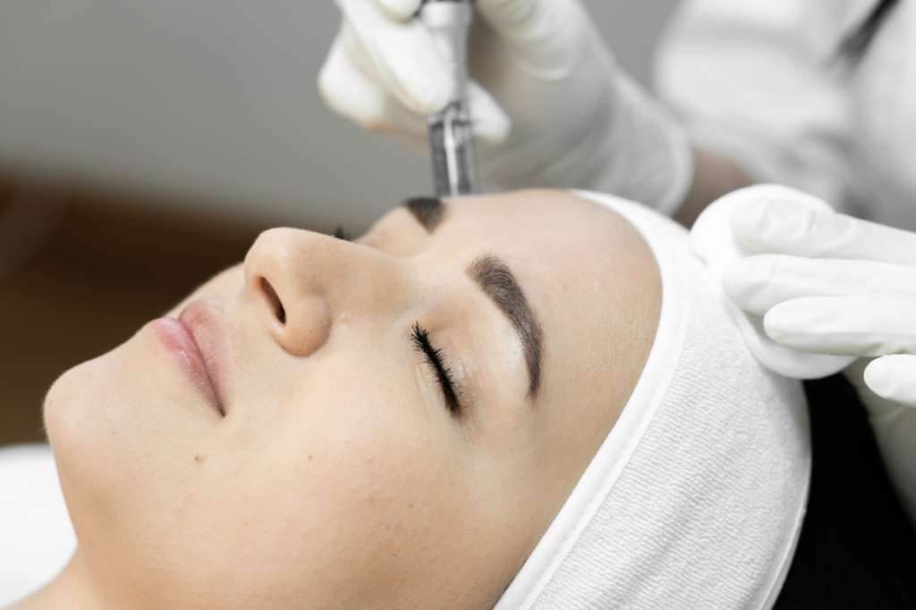 Microneedling Treatment Glendale AZ